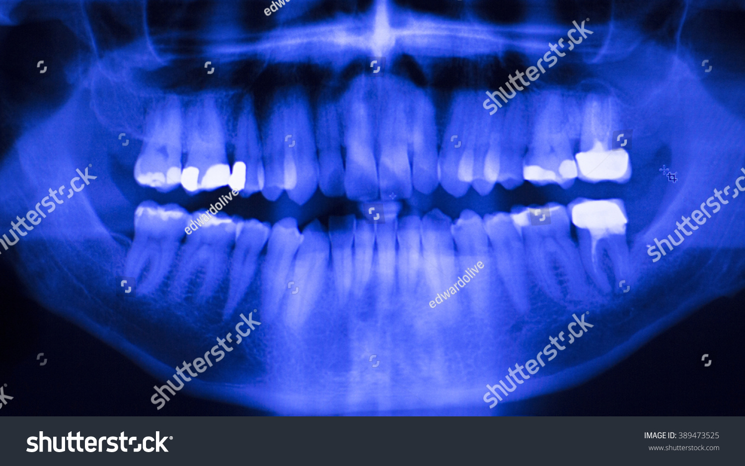 Dental Teeth Fillings Gum Disease Gingivitis Stock Photo 389473525 ...