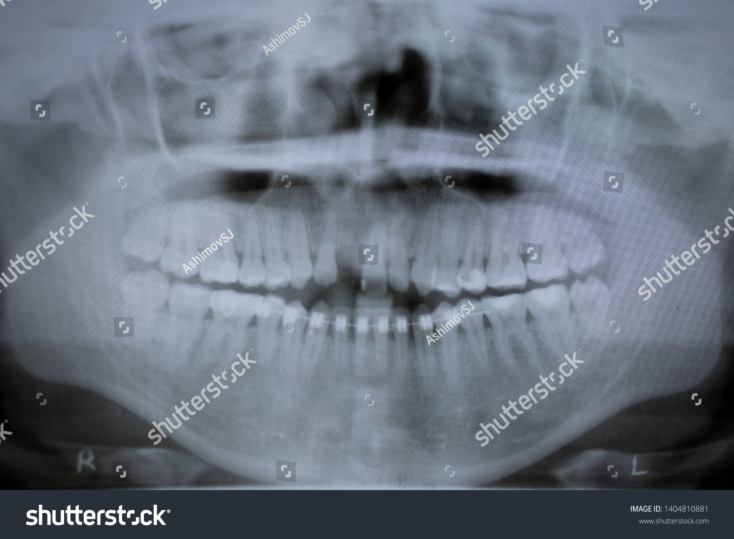 Dental Xray Photo Human Skull Teeth Stock Photo Edit Now 1404810881