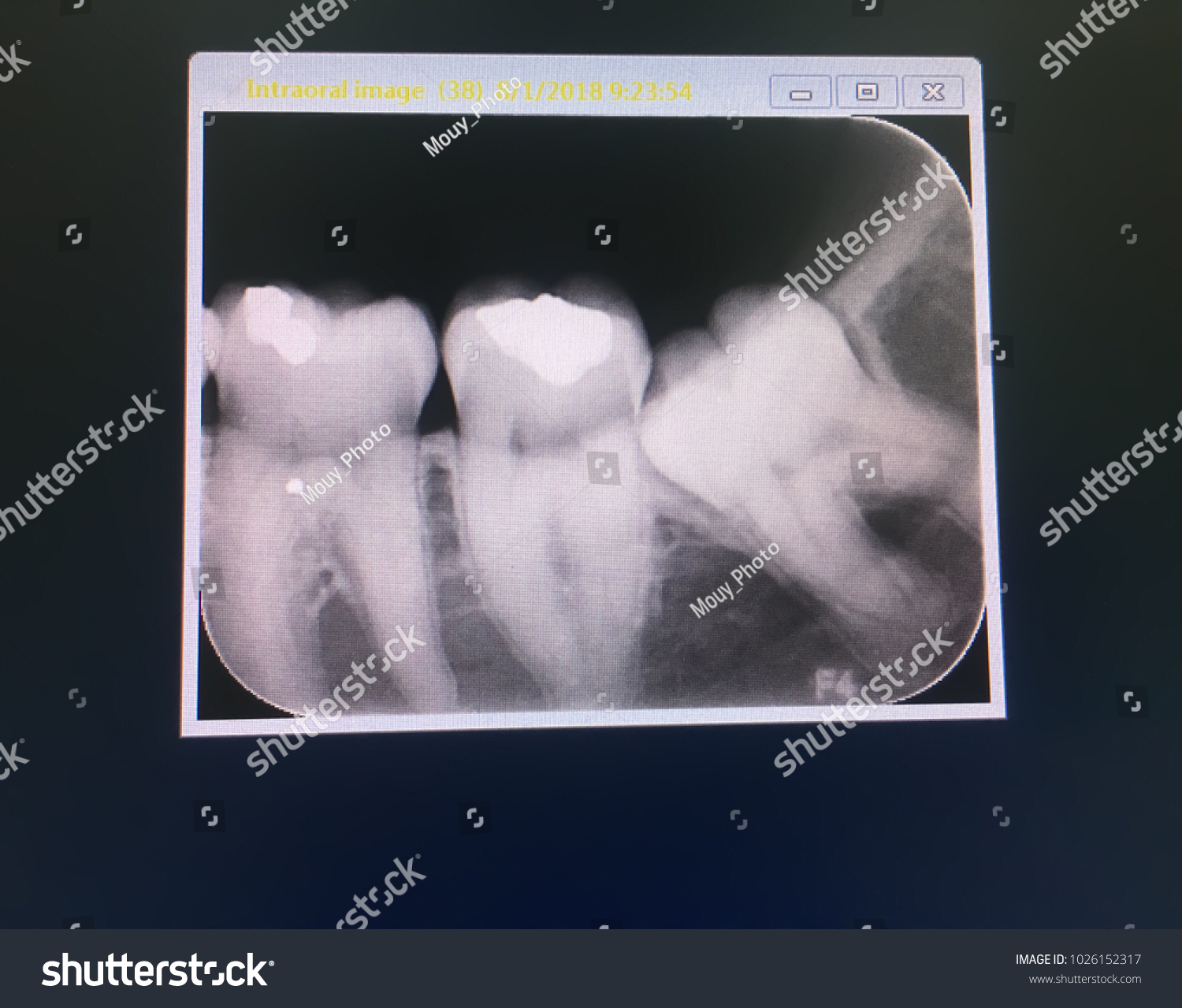 2 Radiologic intra oral Images, Stock Photos & Vectors | Shutterstock