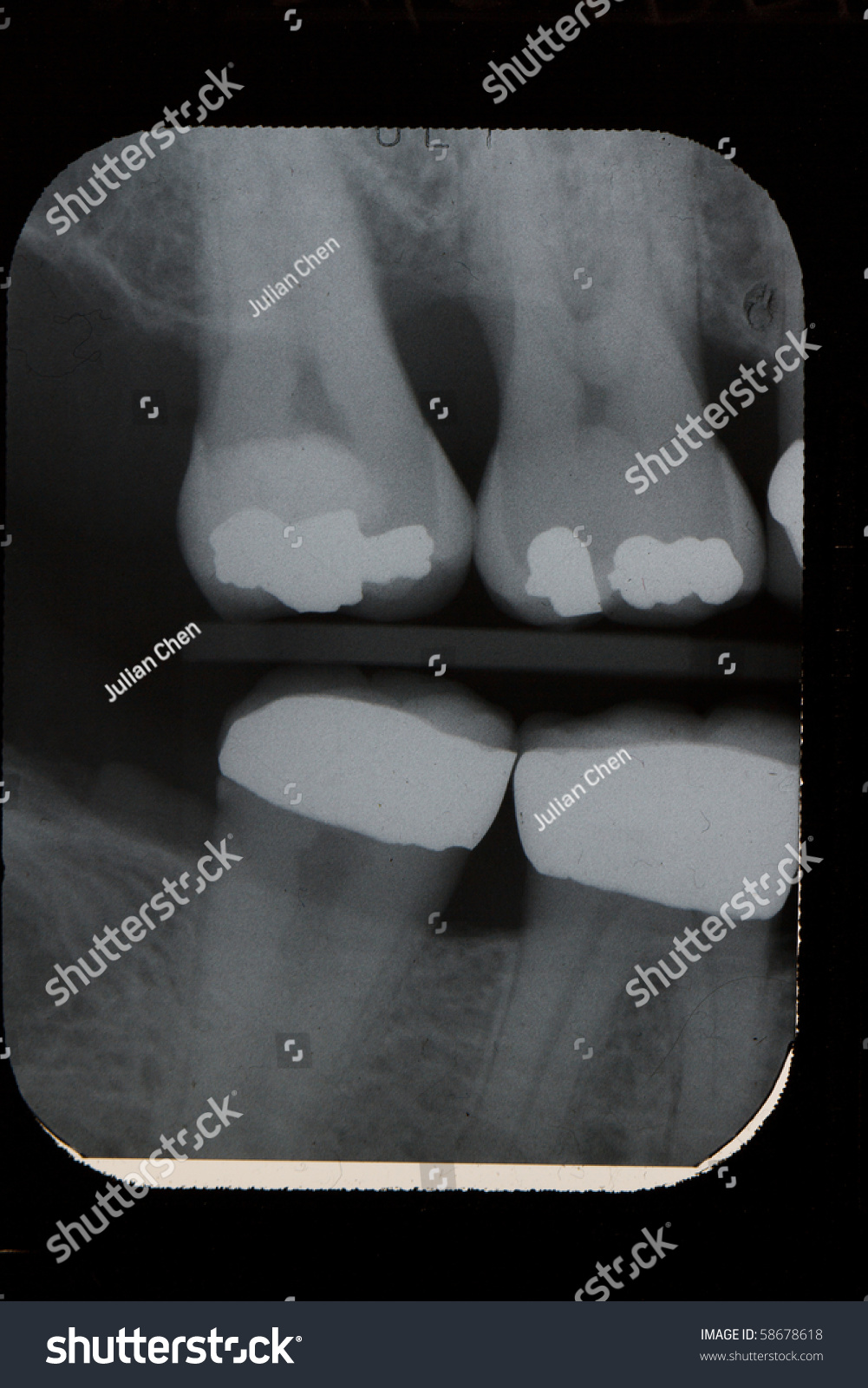 Dental Xray Vertical Bitewings Right Molar Stock Photo 58678618 ...