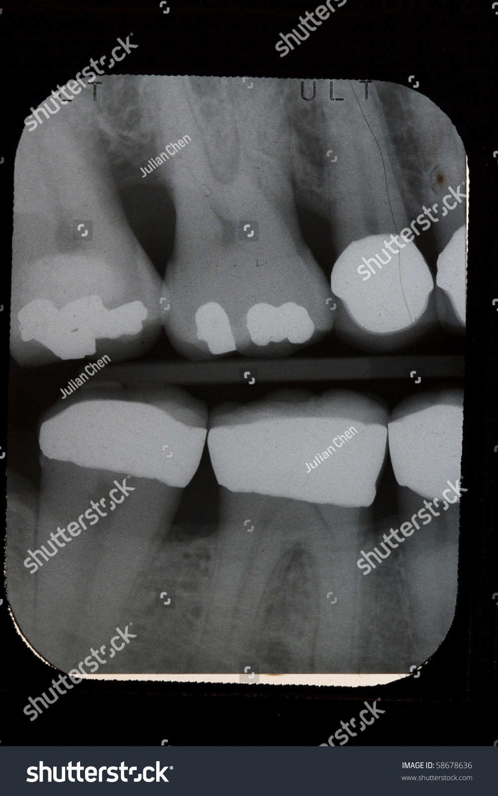 Dental Xray Vertical Bitewings Right Premolar Stock Photo 58678636 ...