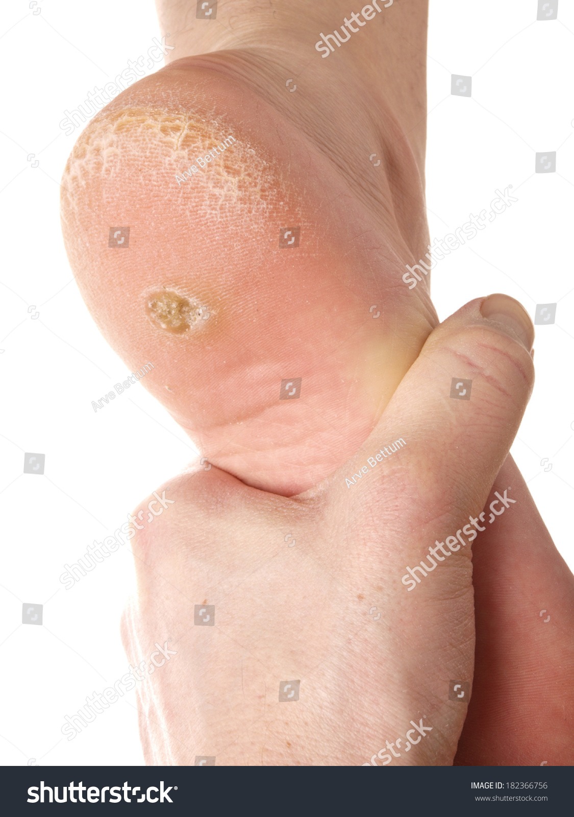 Dermatologist Examining A Foot For Callus And Dry Skin, Towards White ...