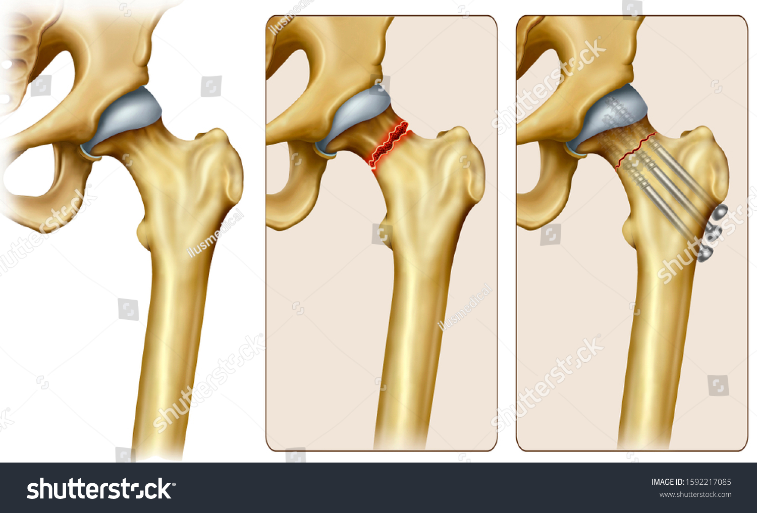 Descriptive Illustration Femoral Fracture Femoral Neck Stock ...