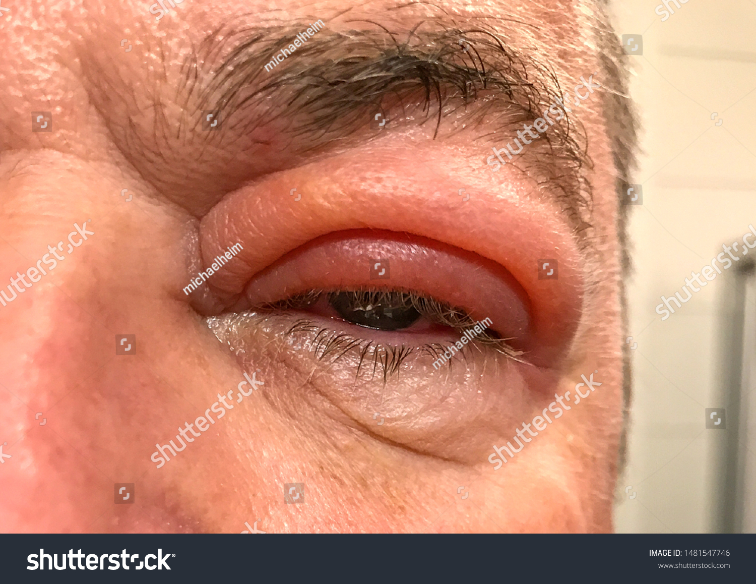 Detail Badly Swollen Upper Eyelid Man Foto De Stock Editar Ahora