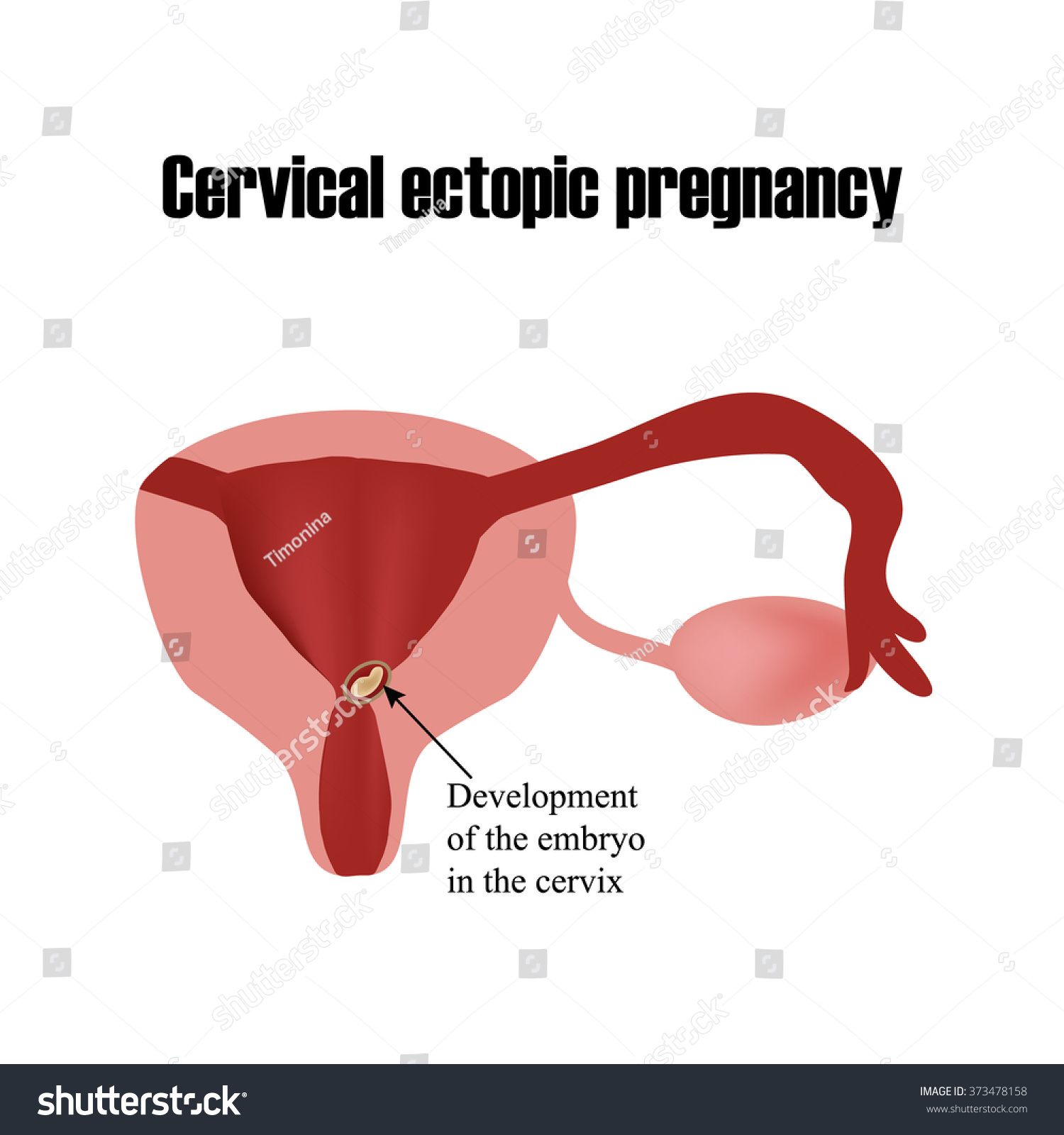 Development Embryo Cervix Ectopic Pregnancy Infographics Stock