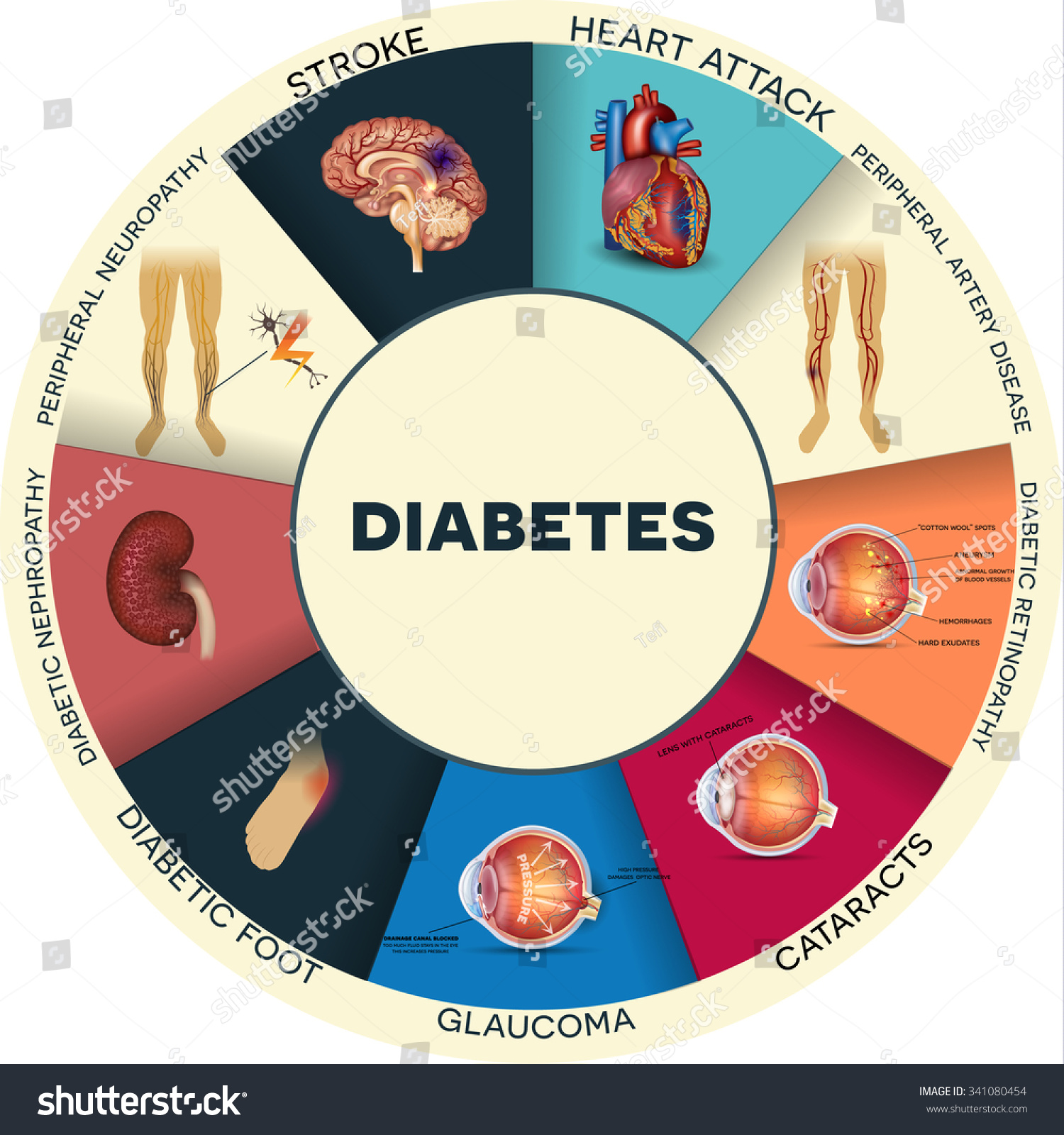 Complications Of Diabetes Wikipedia