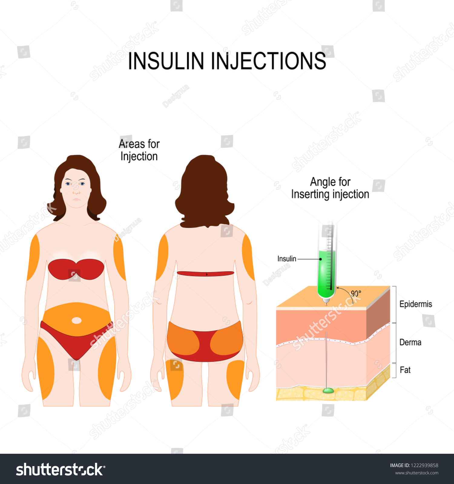 Diabetes Mellitus Insulin Injections Angle Inserting стоковая