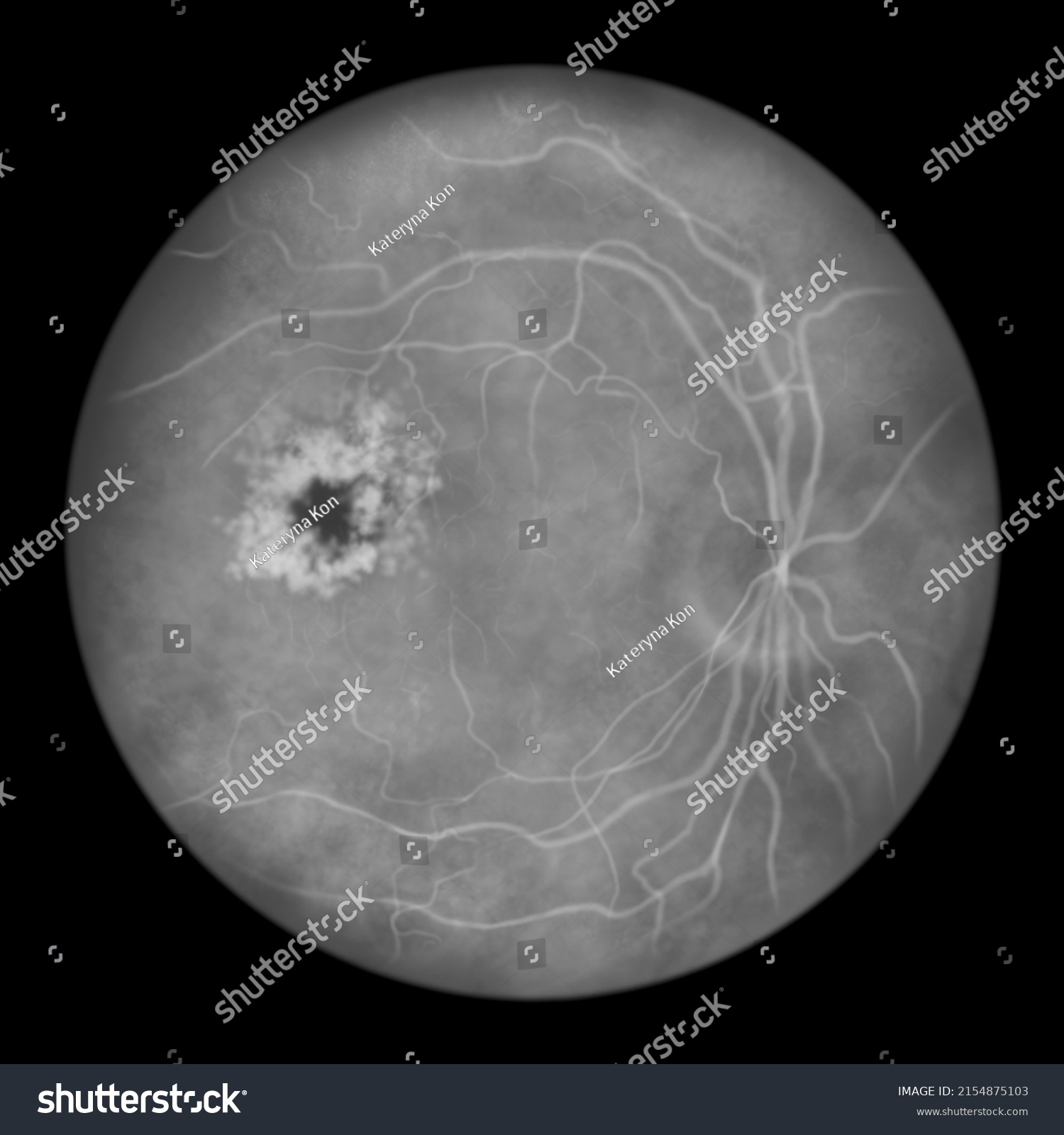 Diabetic Macular Edema Dme Diabetic Retinopathy Stock Illustration ...