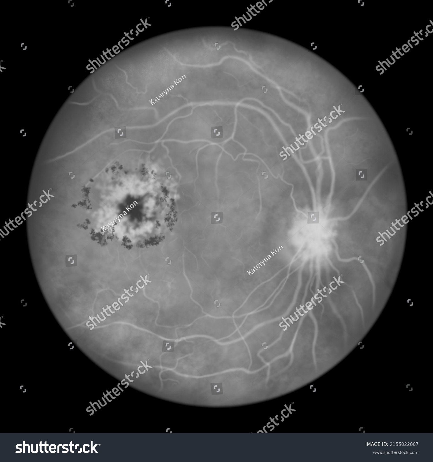 Diabetic Retinopathy Illustration Showing Cystoid Macula Stock ...