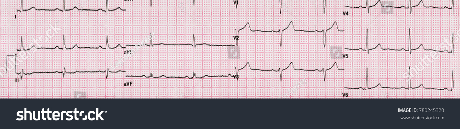 Diagnosis Human Heart Pathology Using Electrocardiogram Stock ...