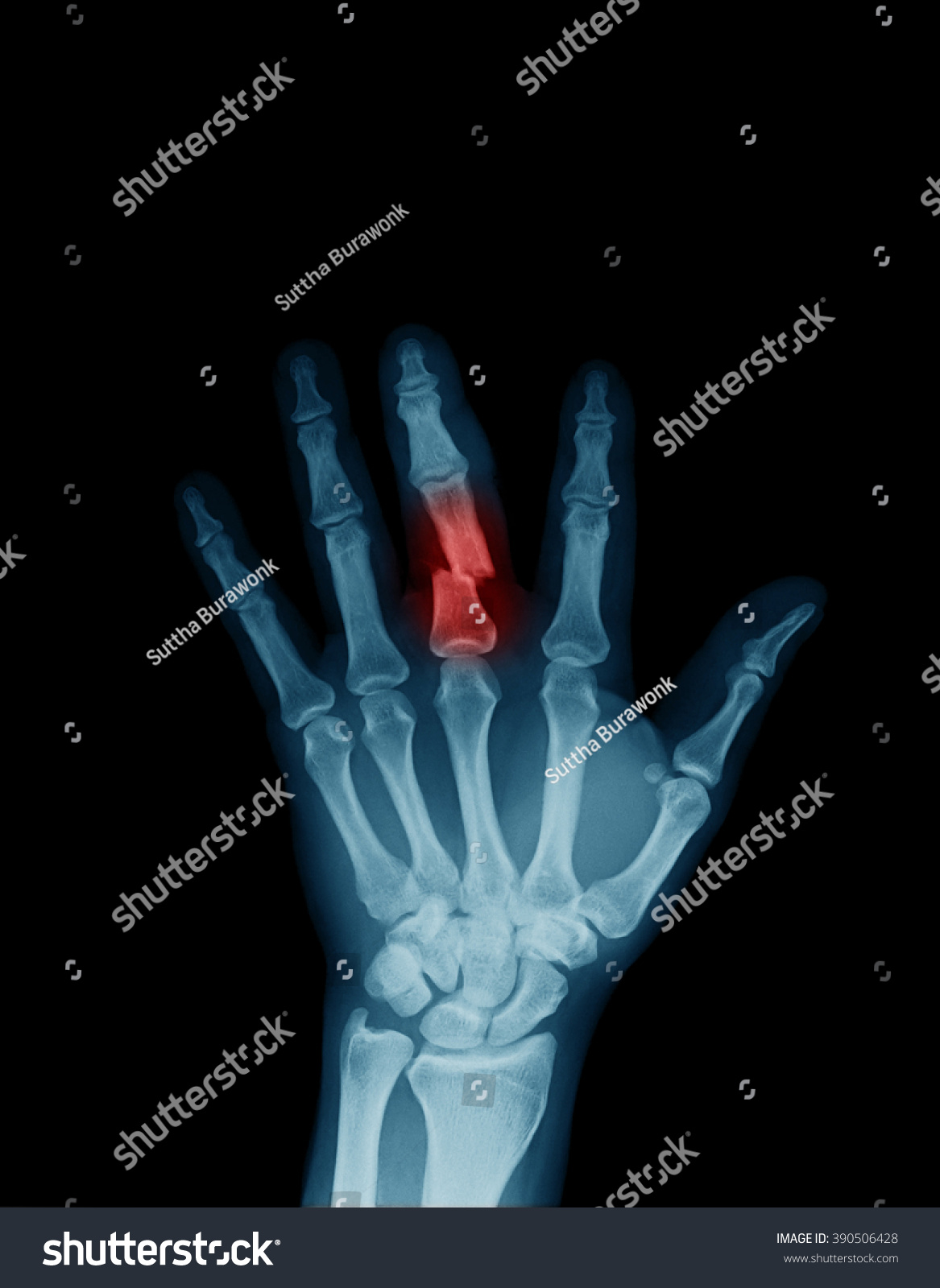 Digital Elbow Wooden Splint Xray Image Stock Photo (Edit Now) 390506428 ...