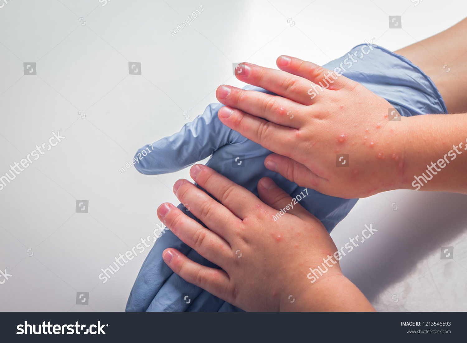 disease-spots-on-childrens-hands-stock-photo-1213546693-shutterstock