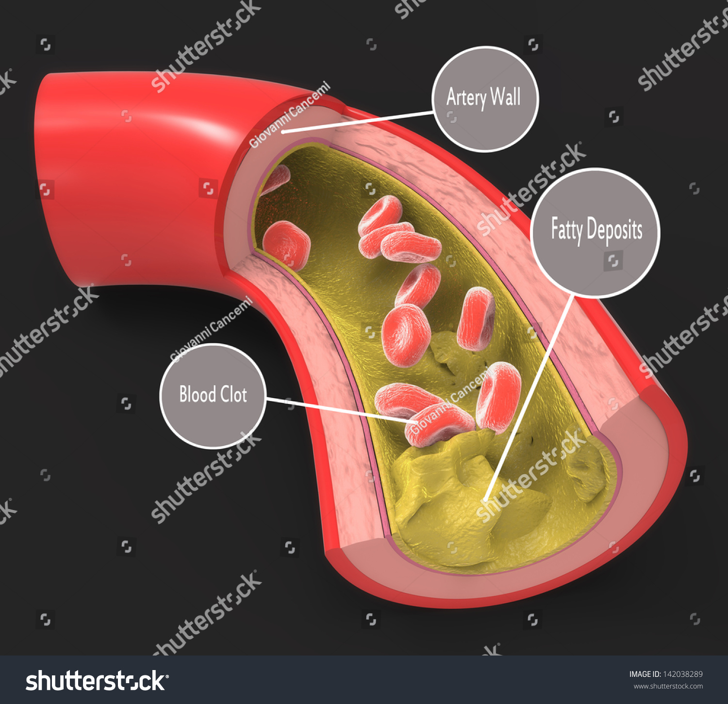 Diseased Artery With Fatty Deposits Stock Photo 142038289 : Shutterstock