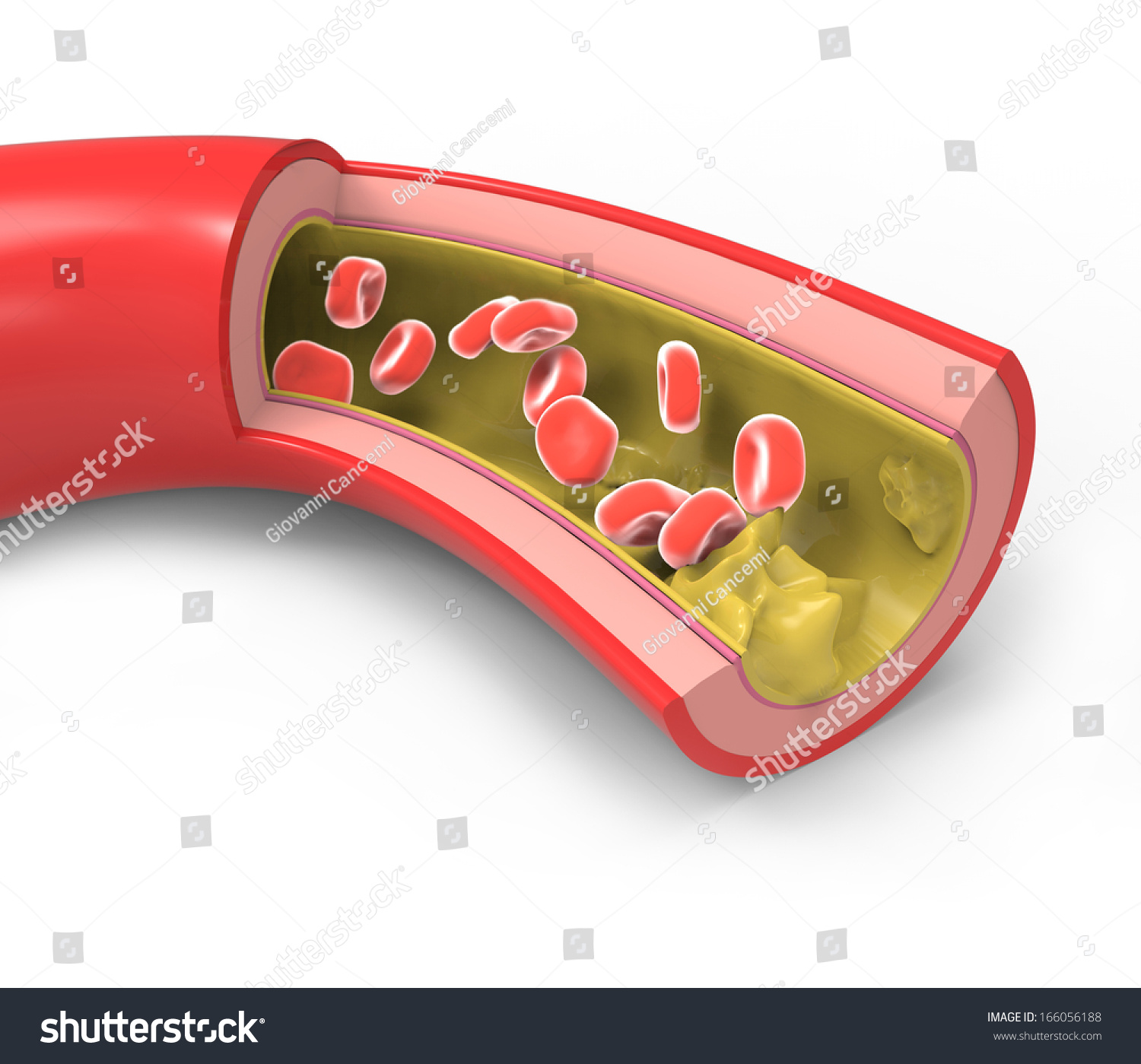 Diseased Artery Fatty Deposits Stock Illustration 166056188 - Shutterstock