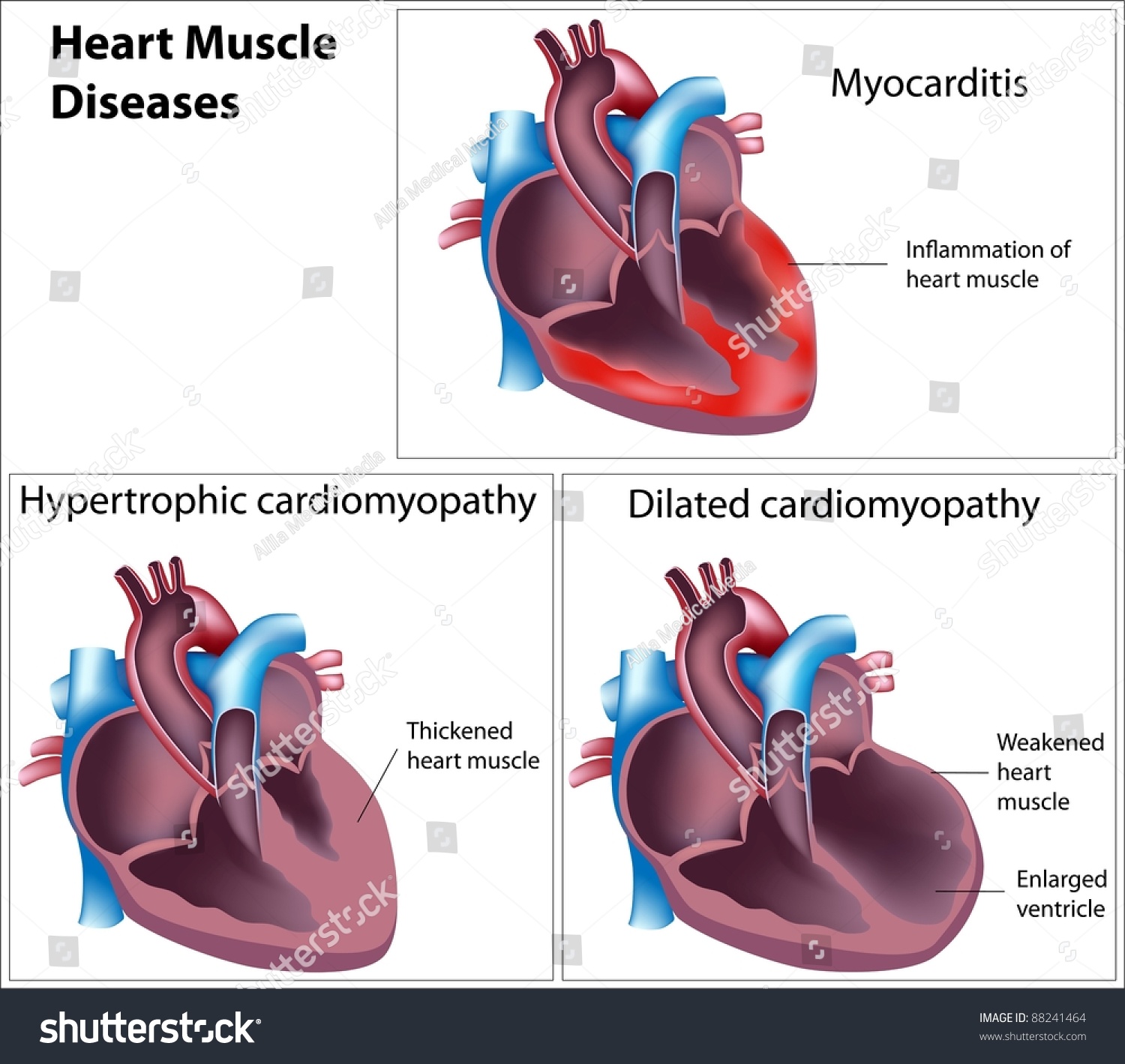 Diseases Heart Muscle Stock Illustration 88241464 - Shutterstock
