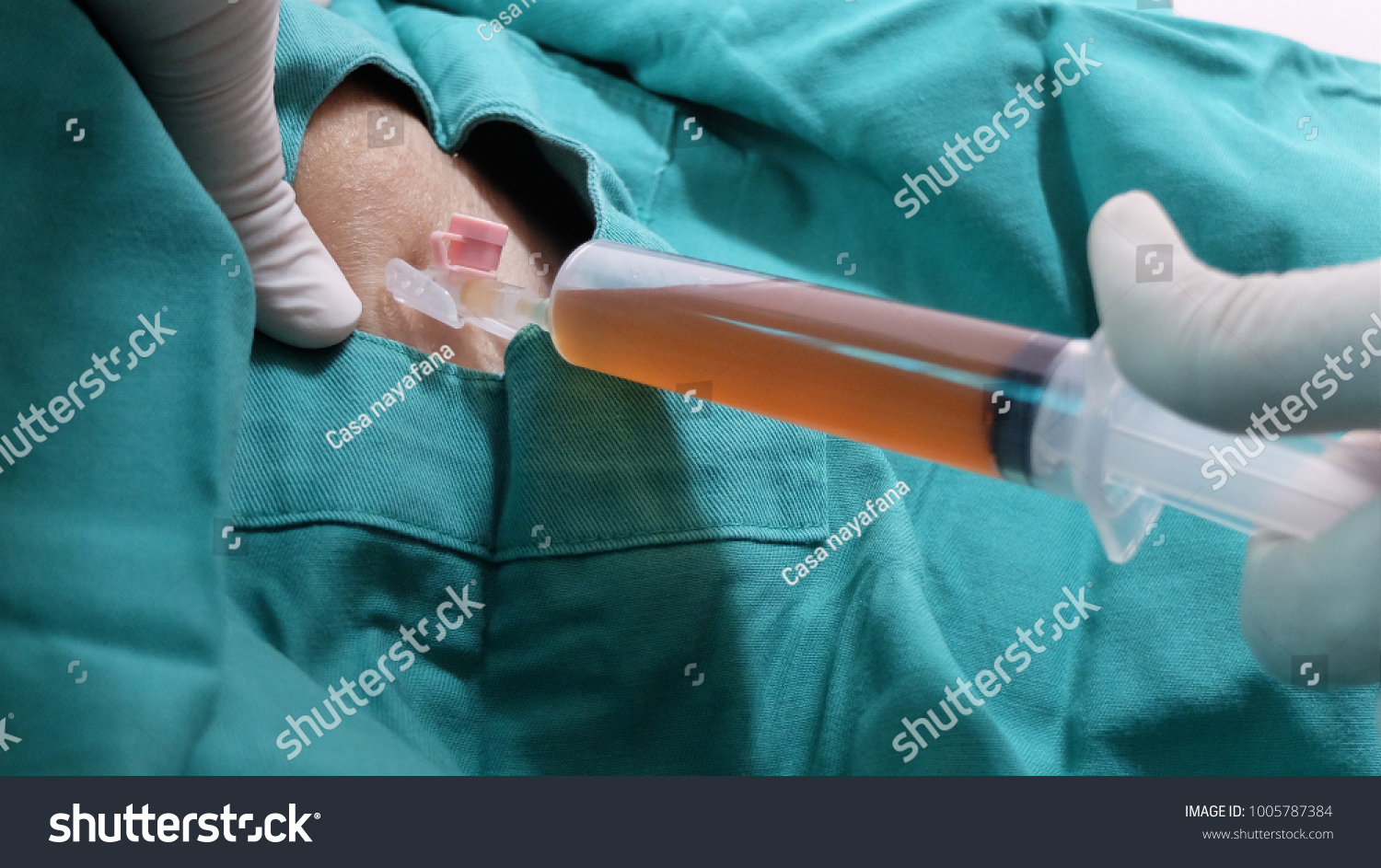 Seroma Imagens Fotos E Vetores Stock Shutterstock