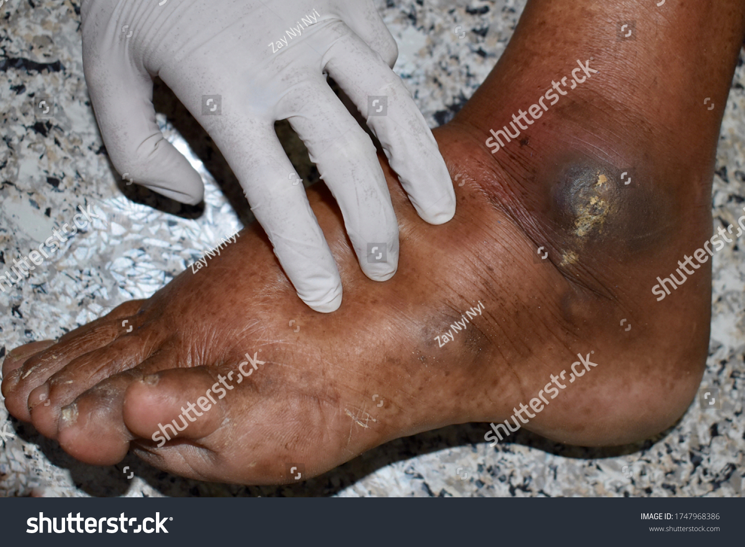 Doctor Examining Swollen Foot Pitting Oedema Stock Photo Edit Now