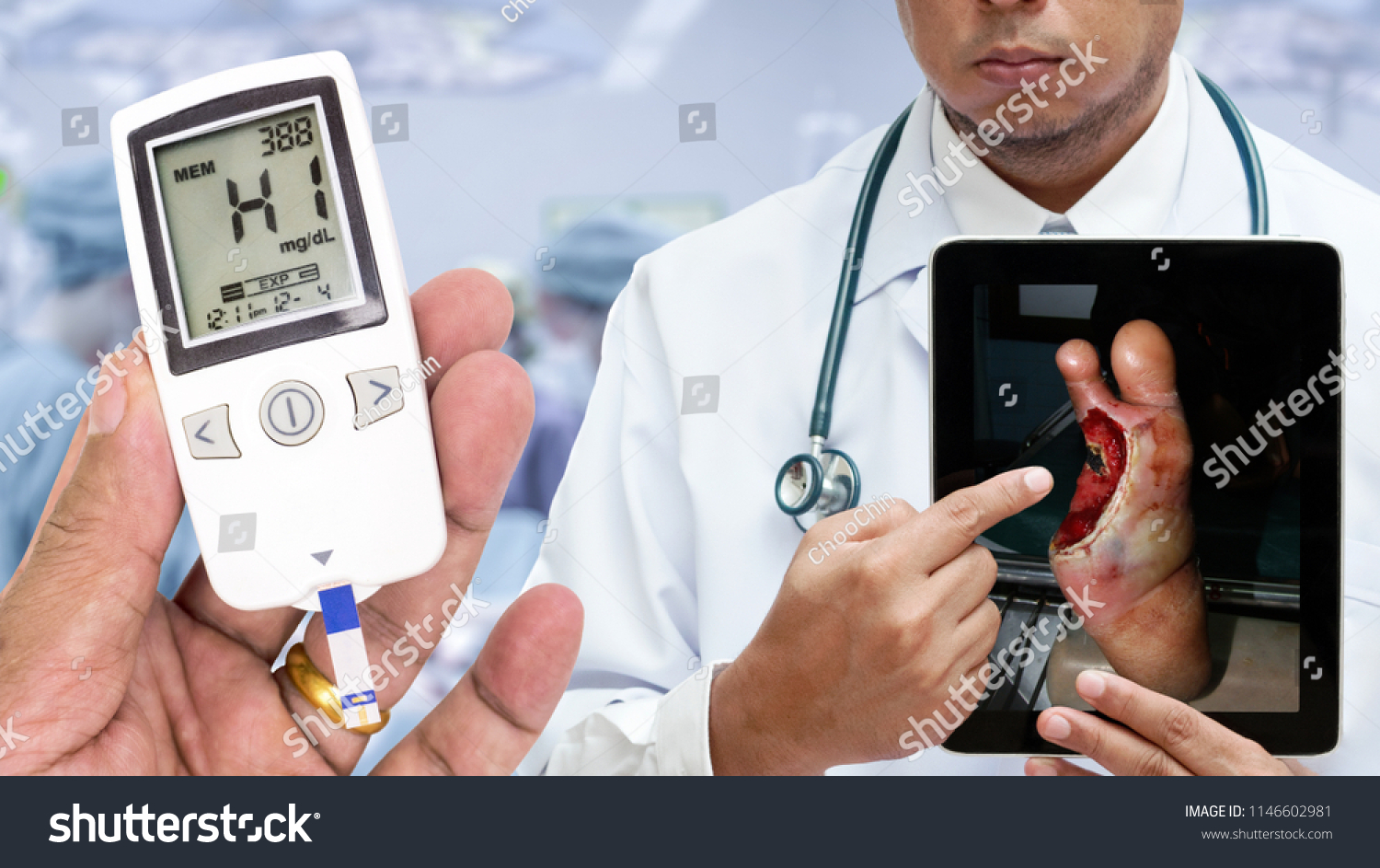 Doctor Showing Picture Diabetic Foot Ulcer Stock Photo Edit Now