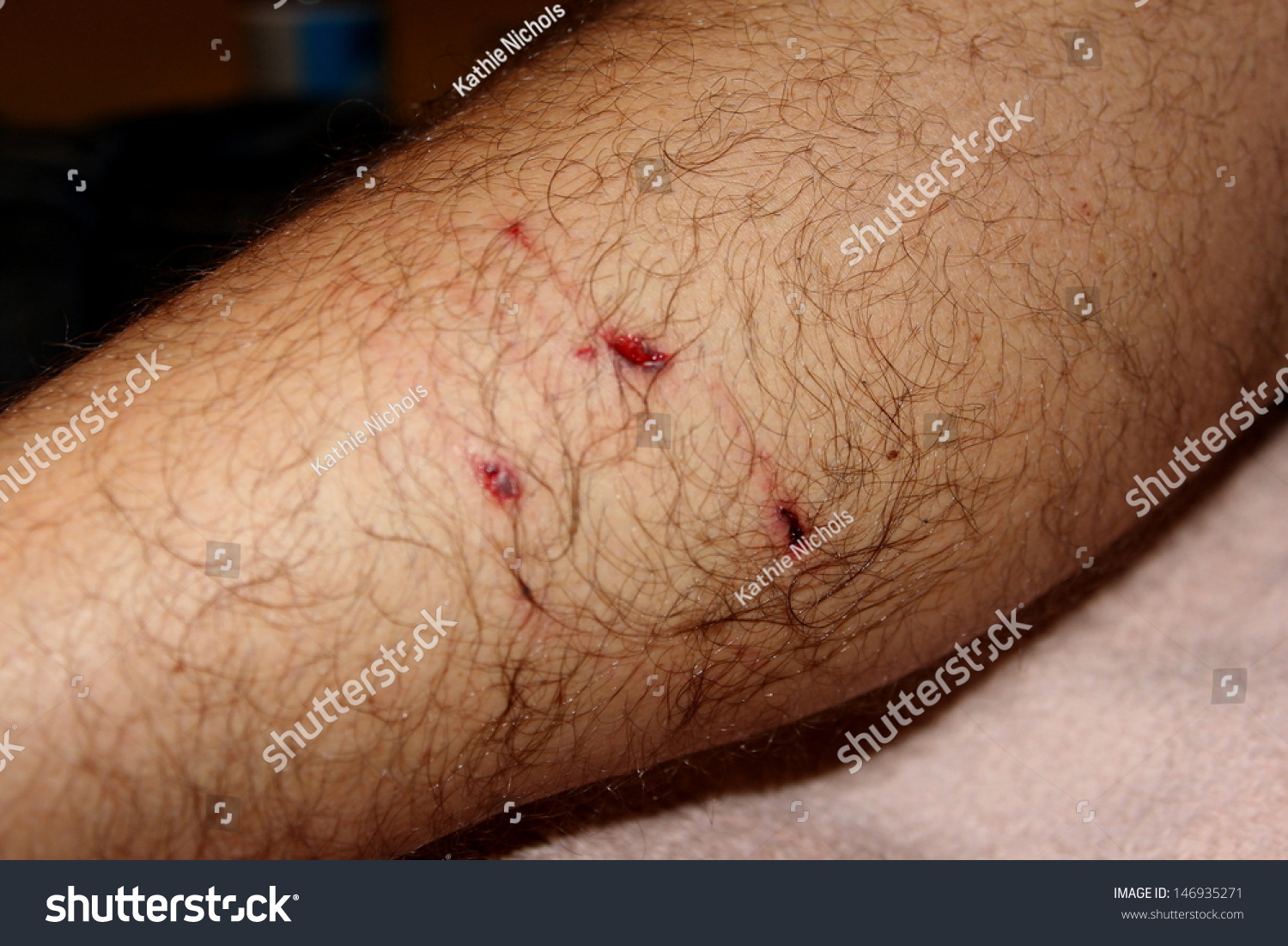 dog-bite-wound-1-stock-photo-146935271-shutterstock