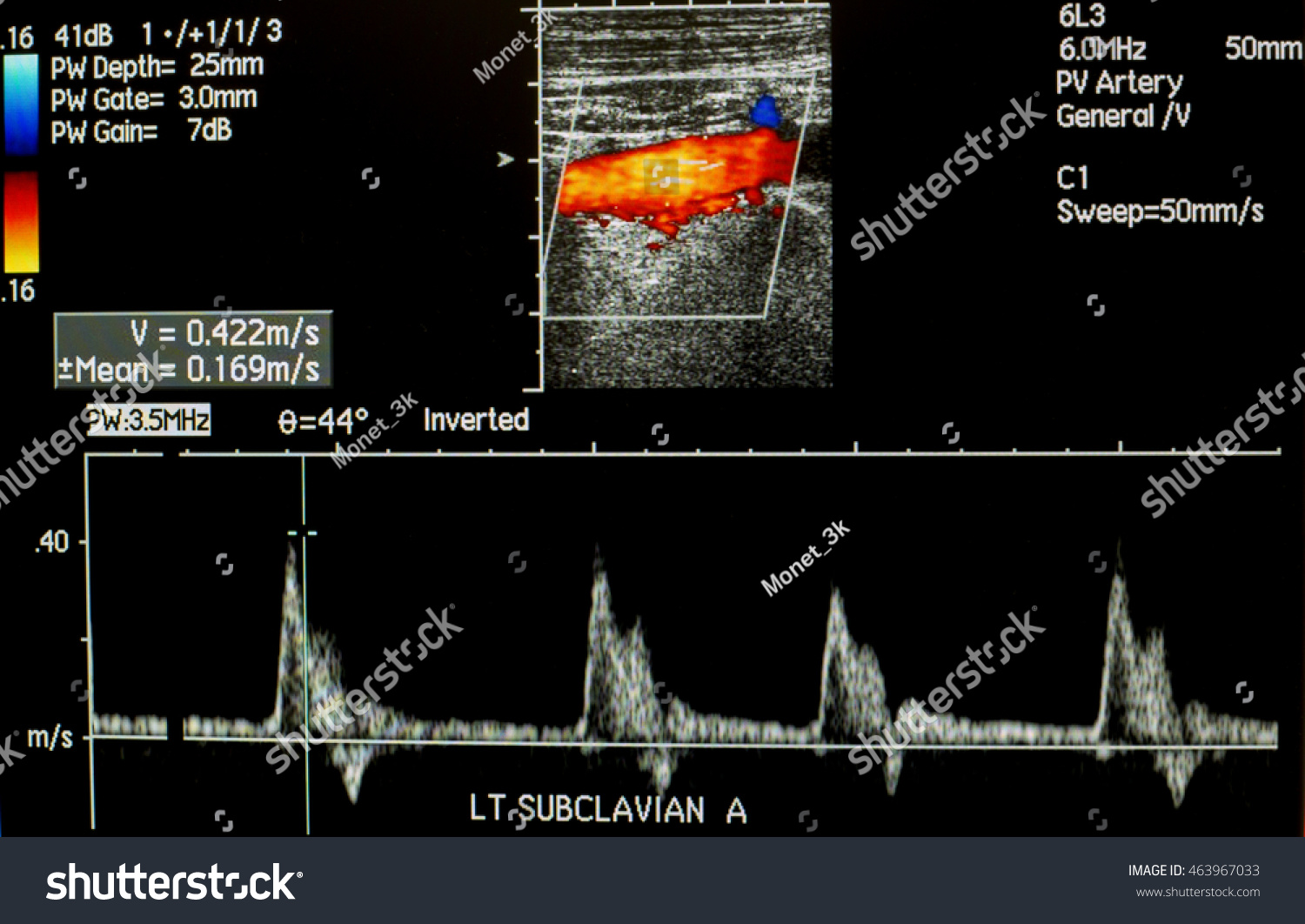 Doppler Ultrasound Left Subclavian Artery Wave Stock Photo (Edit Now ...