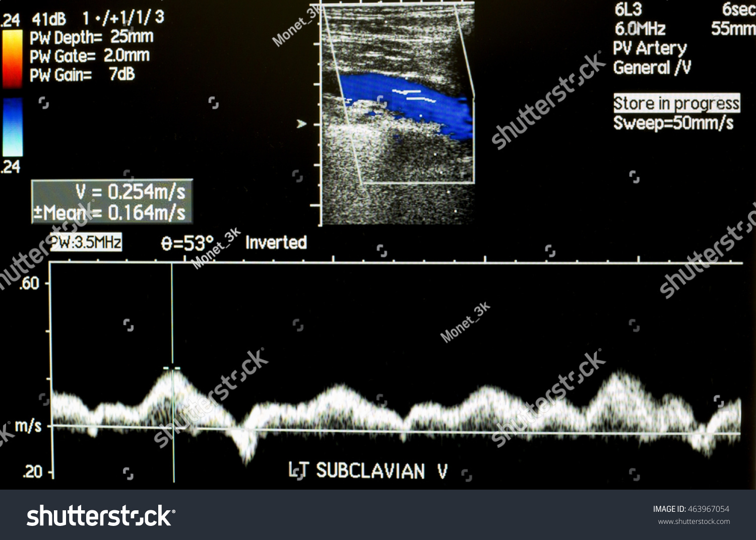 Subclavian Vein Ultrasound