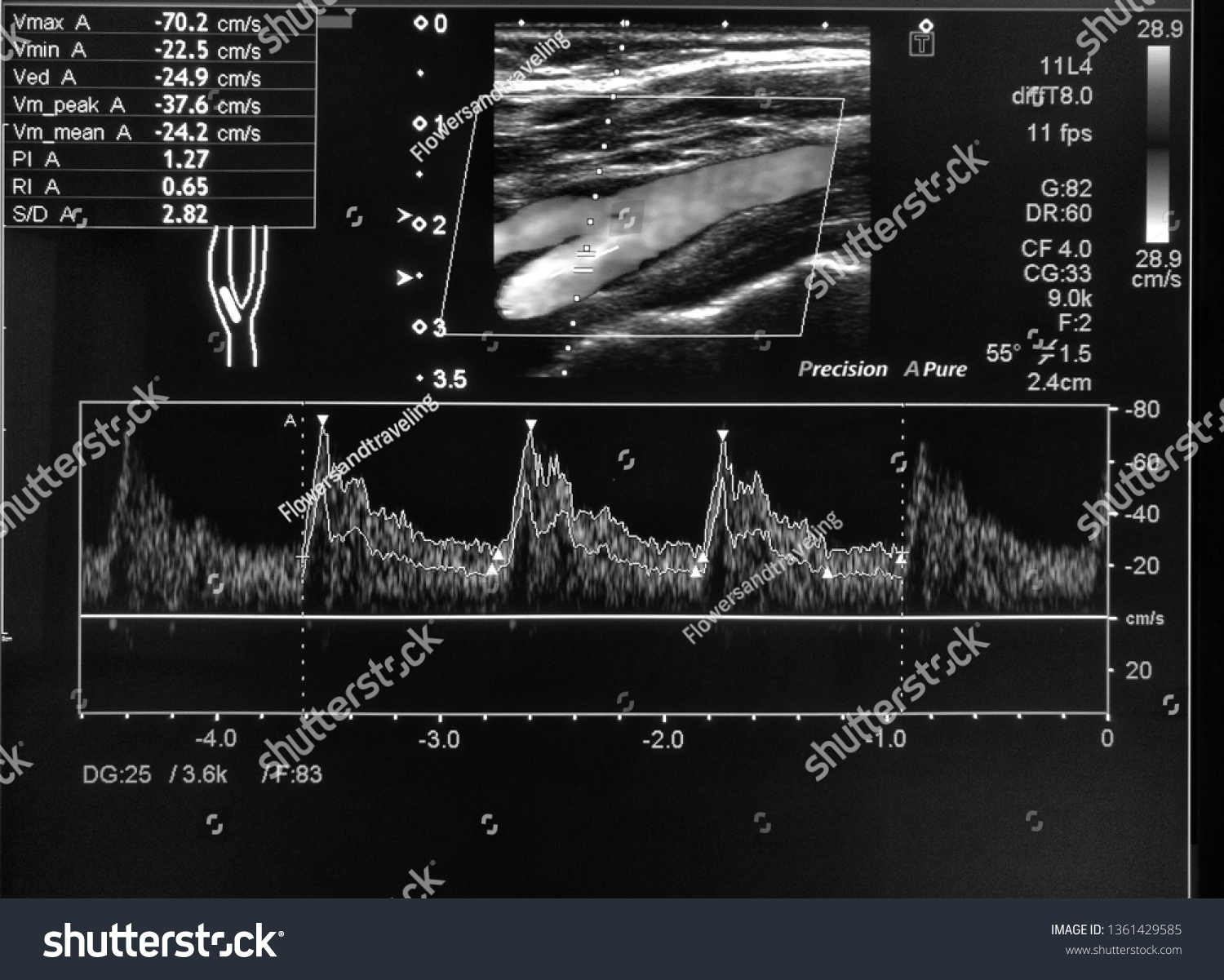 Doppler Ultrasound Normal Carotid Artery Stock Photo (Edit Now) 1361429585