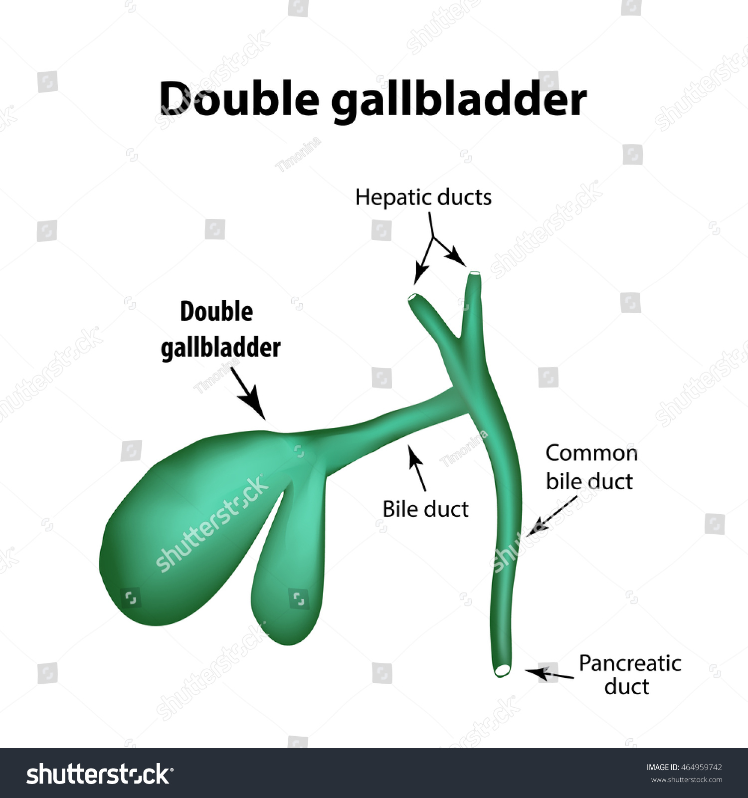 Bend of the gallbladder: causes, clinical manifestations, treatment Bend of the gallbladder: causes, clinical manifestations, treatment