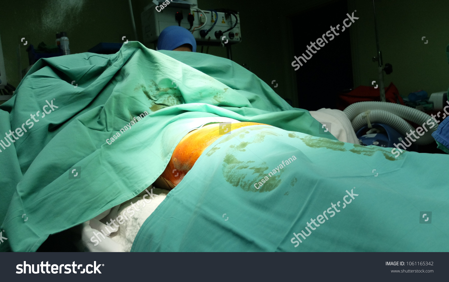 Draping Patient Abdomen Sterile Cloth Before Stock Photo Edit Now