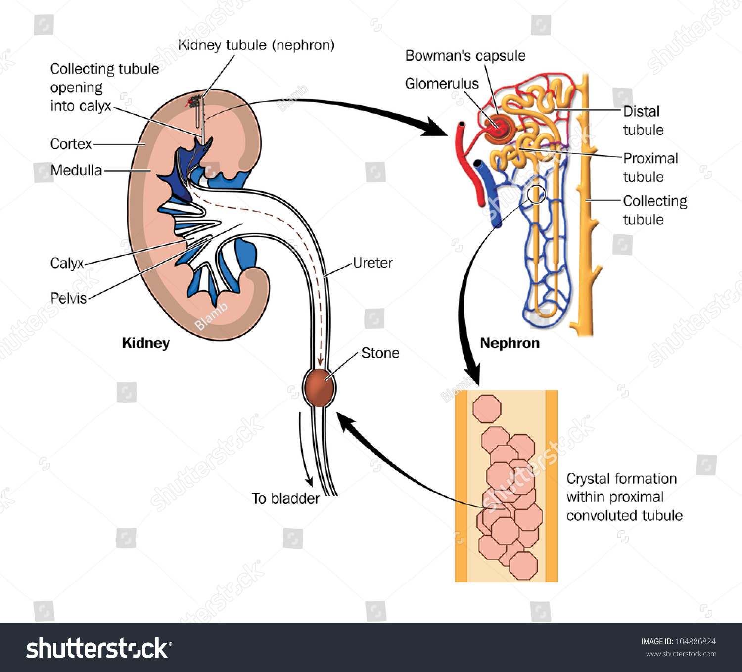 Drawing To Show The Formation Of A Kidney Stone, With Detail Of Crystal ...