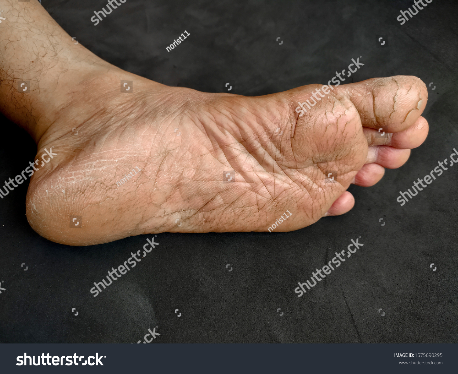 cracked soles