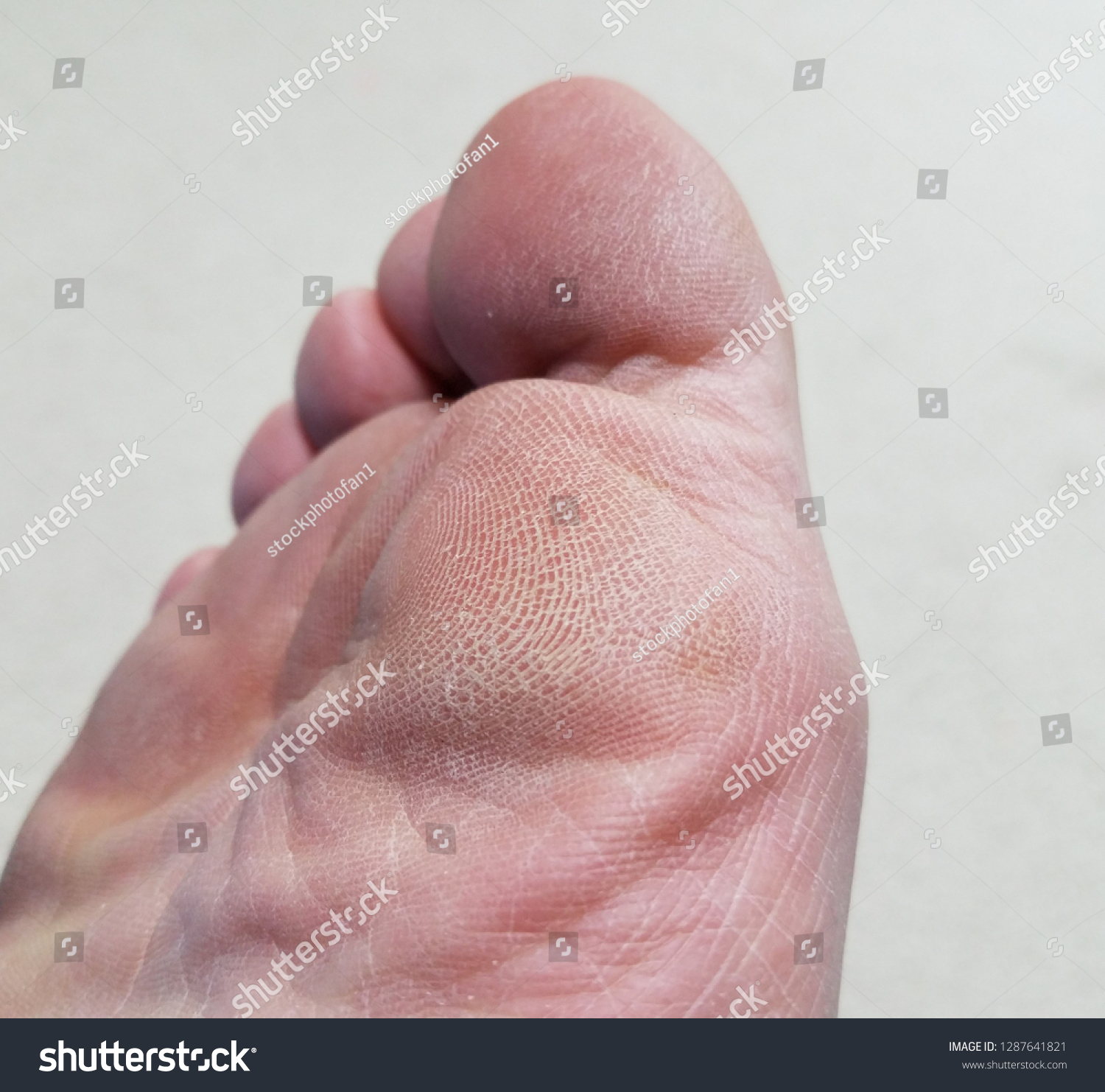 dry flaky soles of feet