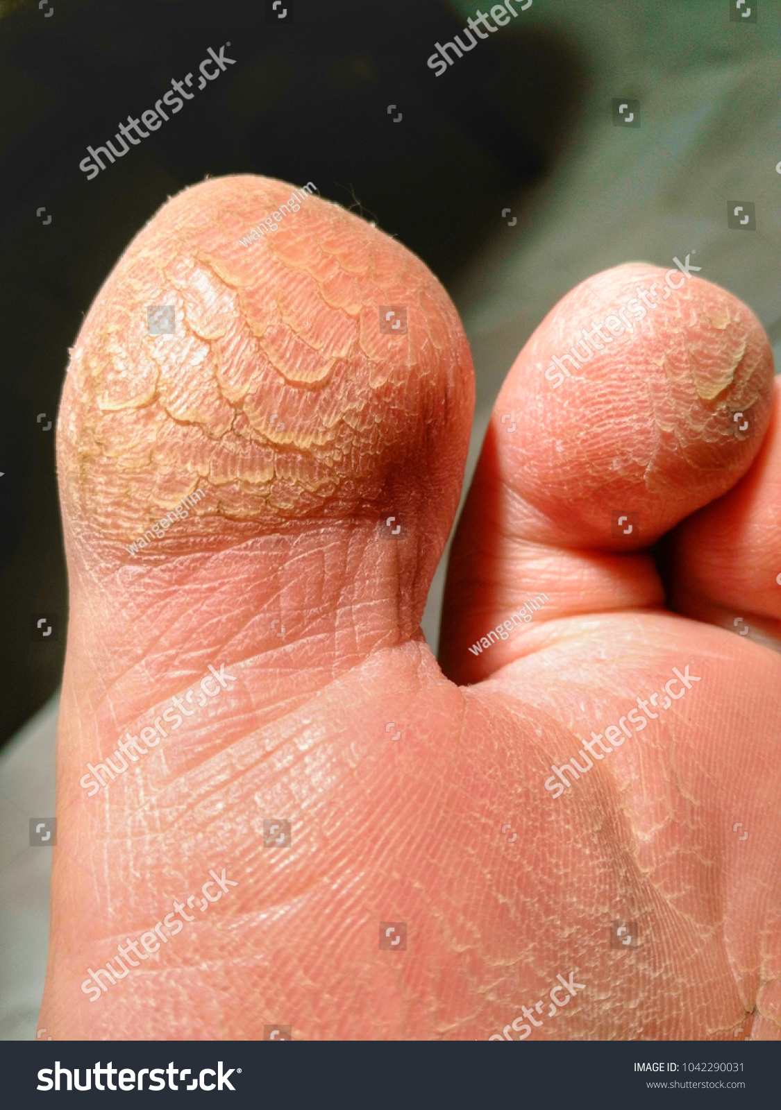 dry cracked toes