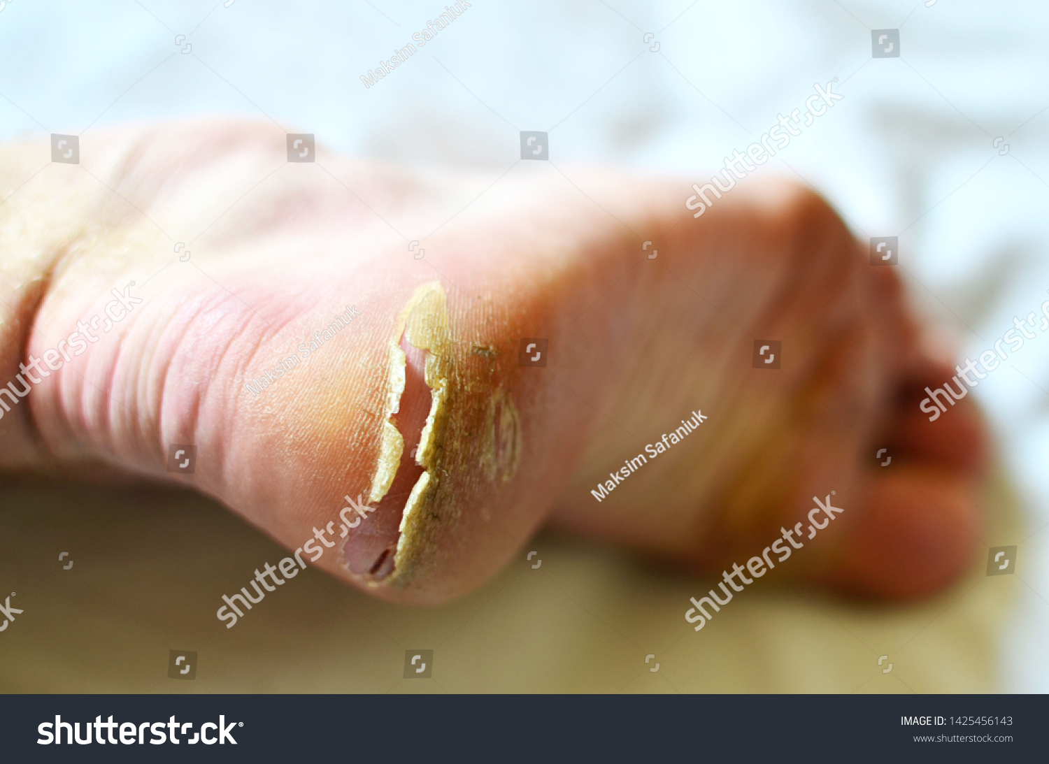 cracking calluses on feet