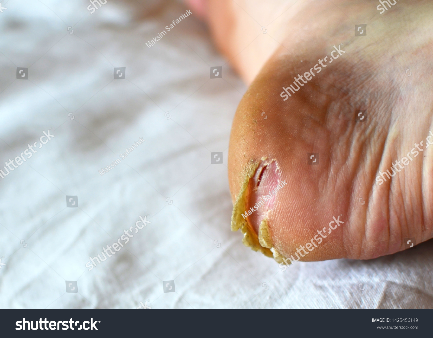 Dry Cracked Heel Callus On Foot Stockfoto Redigera Nu 1425456149