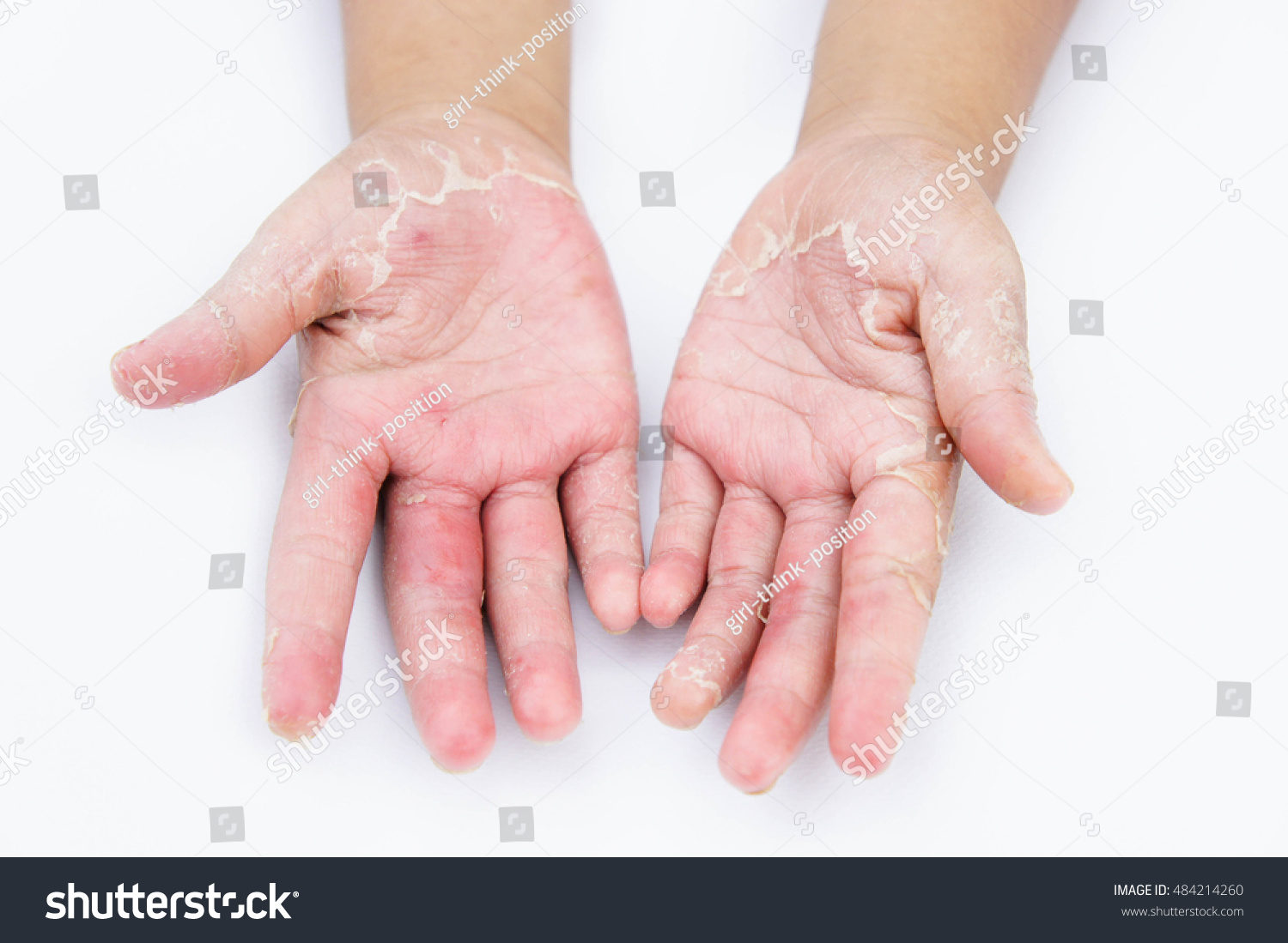 Dry Hands Peel Contact Dermatitis FungalẢnh Có Sẵn484214260 Shutterstock 0134