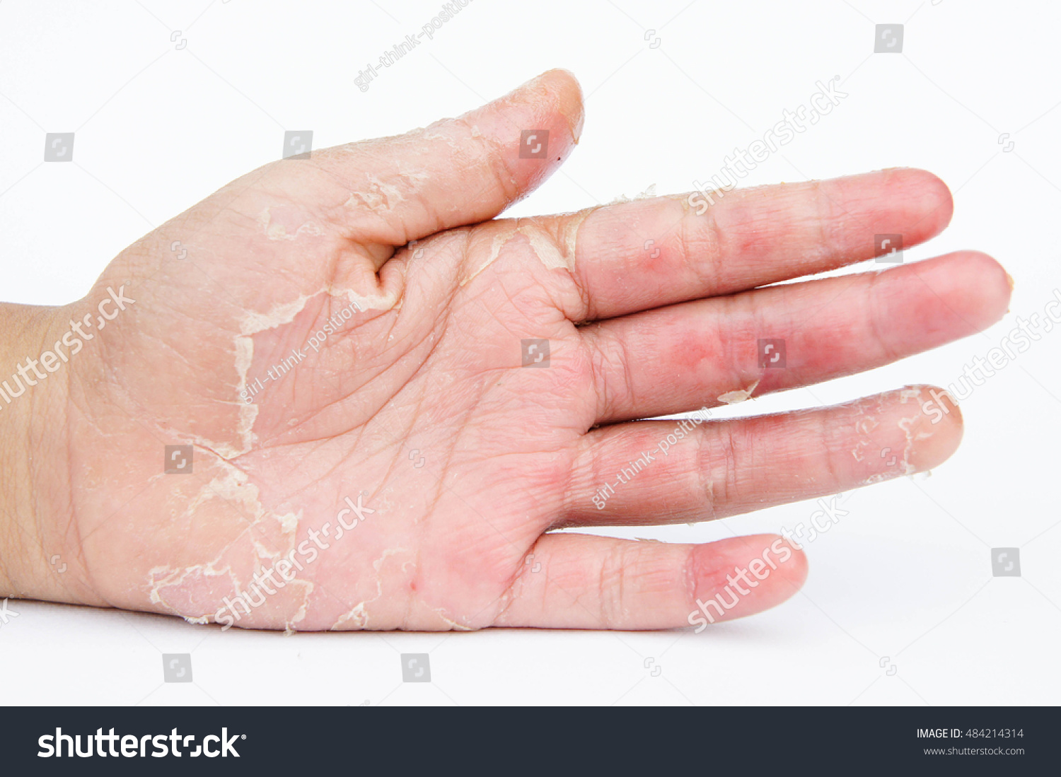 Dry Hands Peel Contact Dermatitis Fungal Stock Photo (Edit Now) 484214314