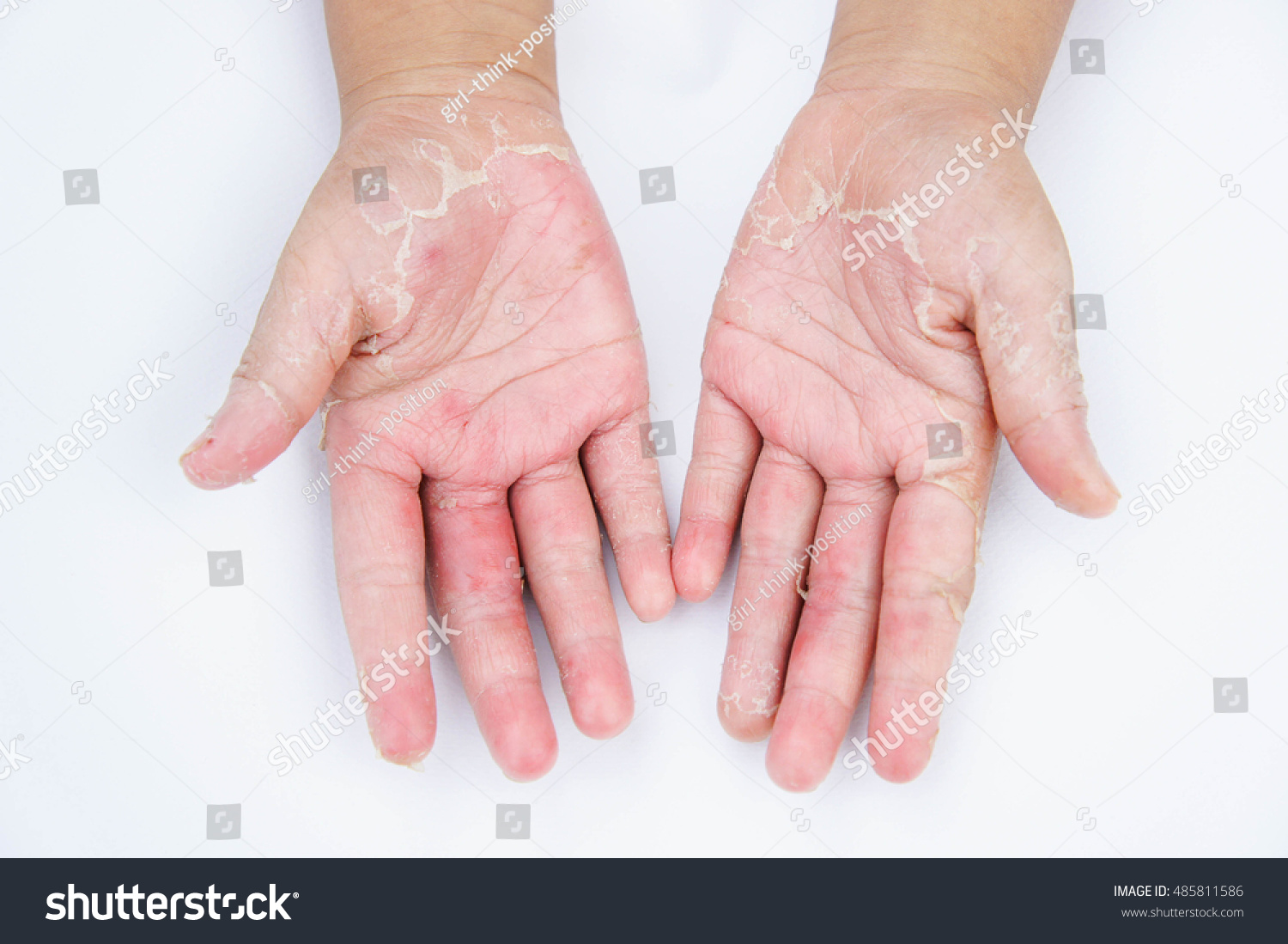 Dry Hands Peel Contact Dermatitis Fungal Stock Photo 485811586 ...