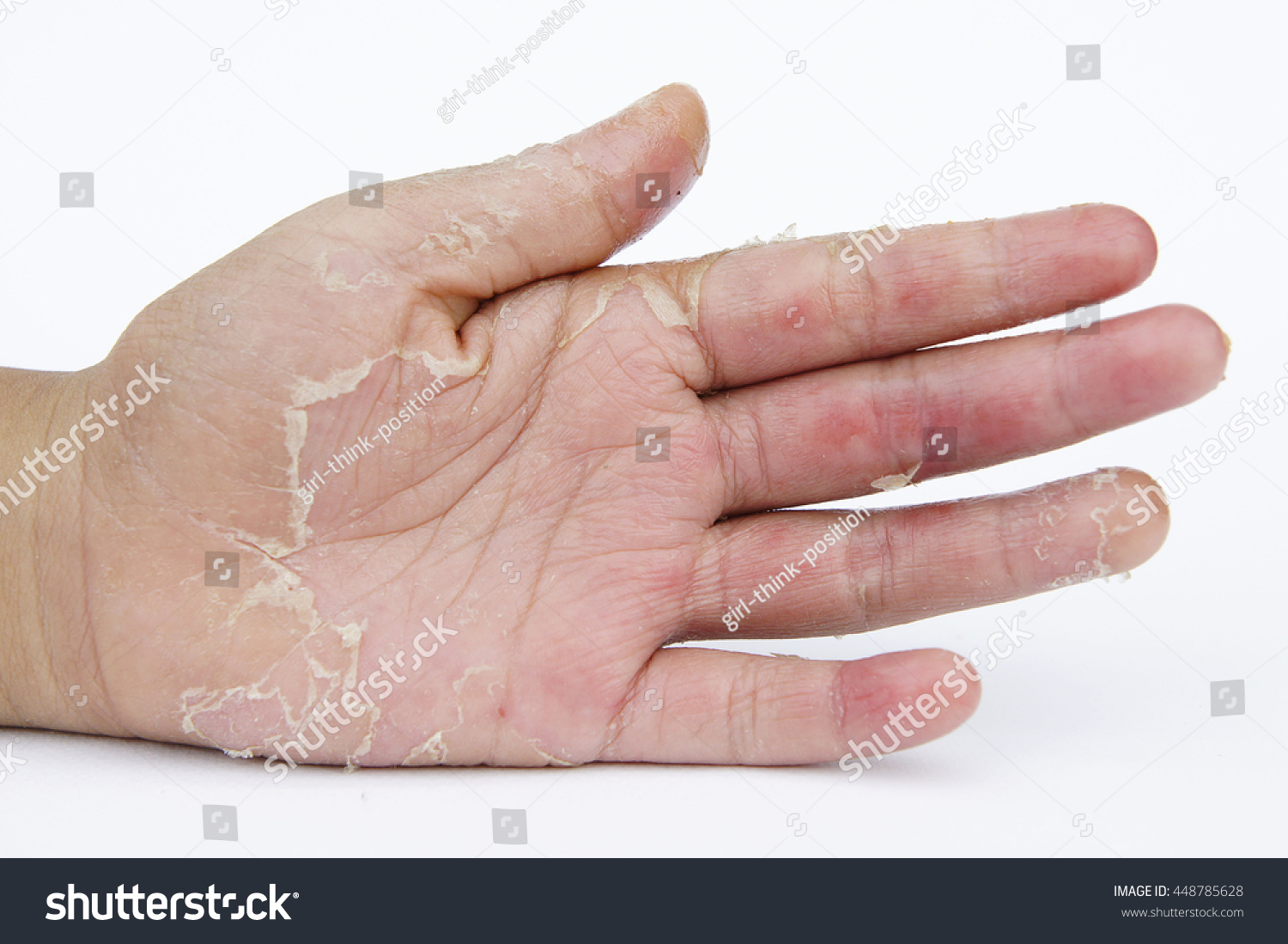 dry-hands-peel-dermatitis-eczema-stock-photo-edit-now-448785628