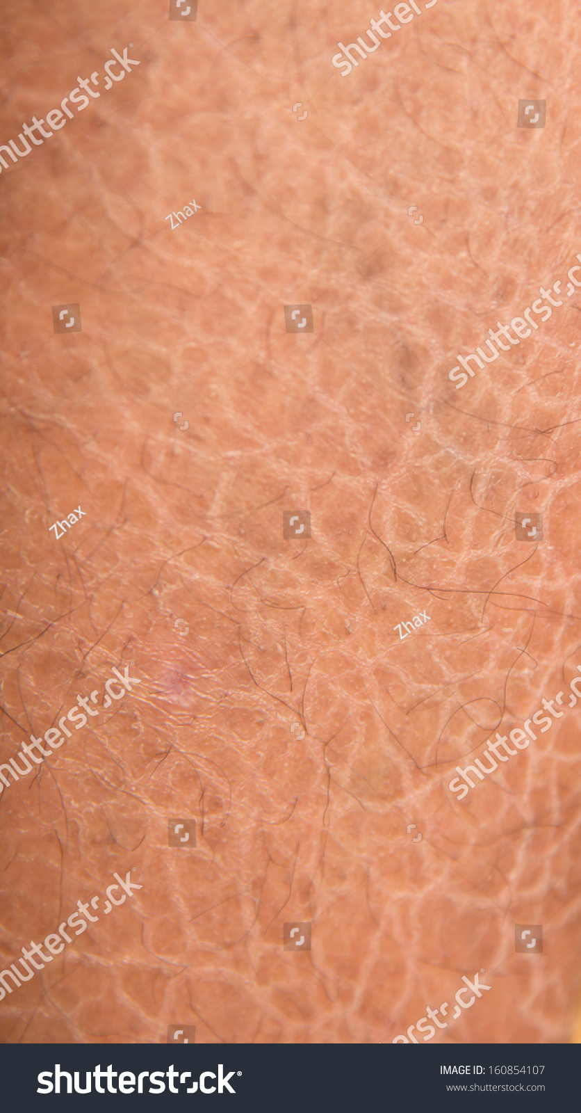 Dry Skin Ichthyosis Detail Stock Photo 160854107 - Shutterstock