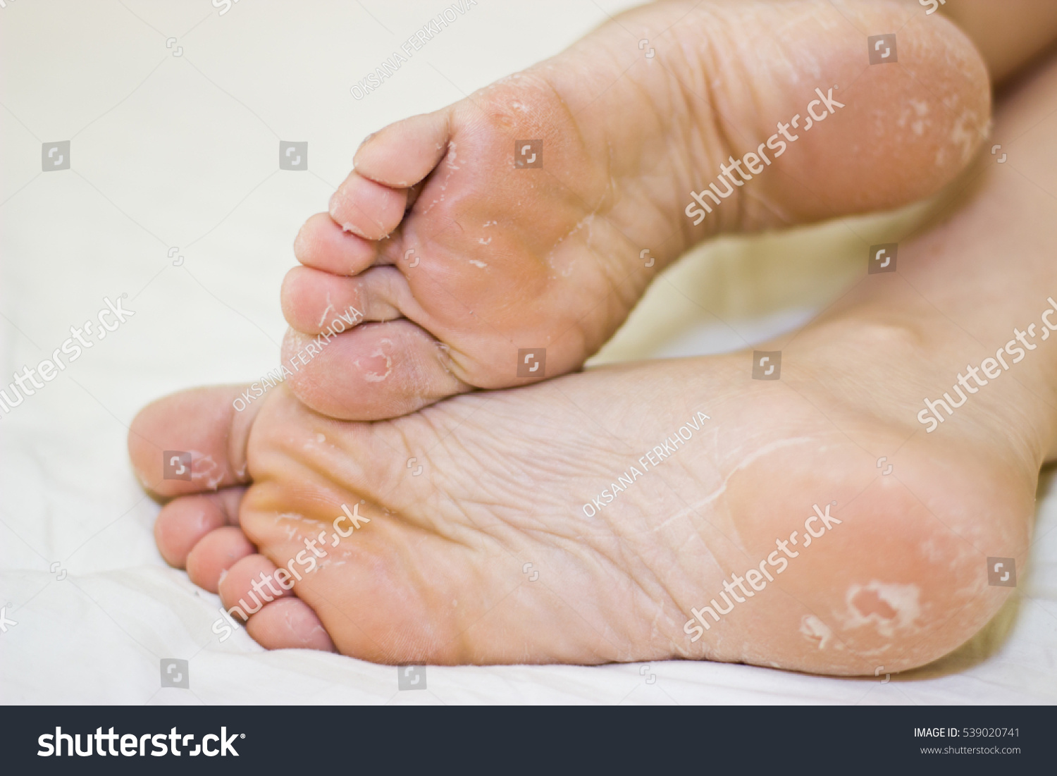 dry-skin-feet-foot-treatment-after-stock-photo-539020741-shutterstock