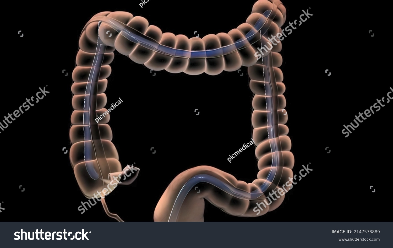 During Colonoscopy Long Fleible Tube Colonoscope Stock Illustration