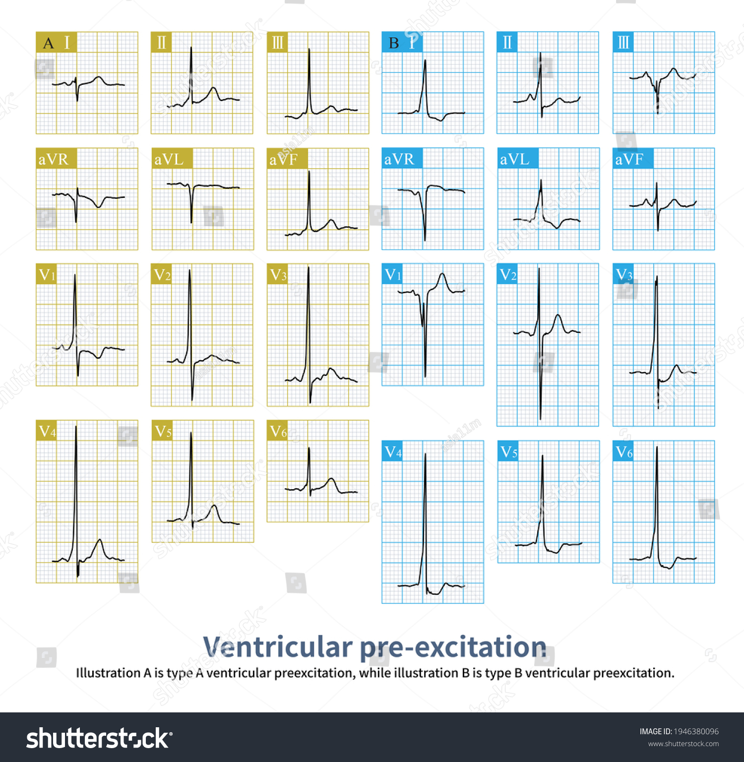 During Ventricular Pre Excitation Qrs Wave Stock Illustration ...