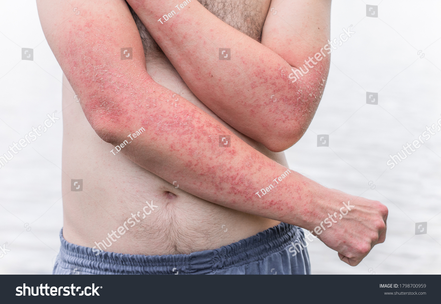 Dyshidrotic Autoimmune Eczema Patient Concept Health Stock Photo (Edit