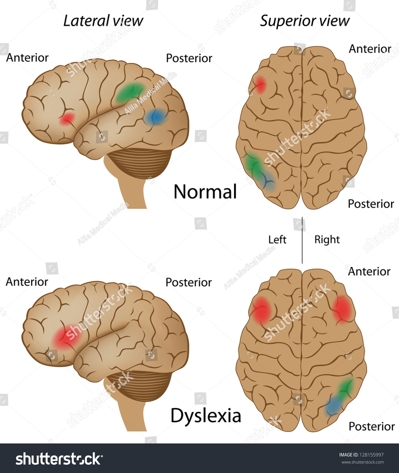 Dyslexia Brain Activity Stock Illustration 128155997 | Shutterstock