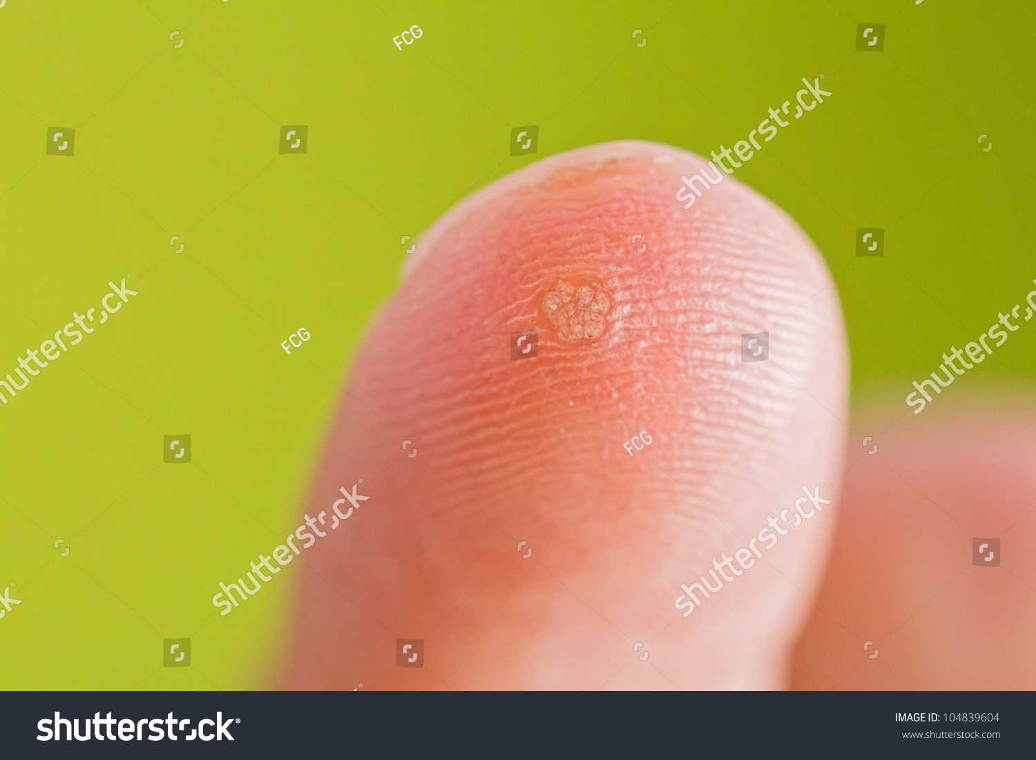 Early Stage Verruca Formation Over Finger Stock Photo 104839604 ...