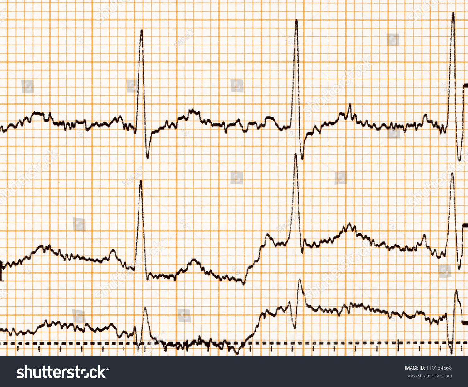 Ecg Diagram, Ecg (Electrocardiogram) Paper Stock Photo 110134568 ...