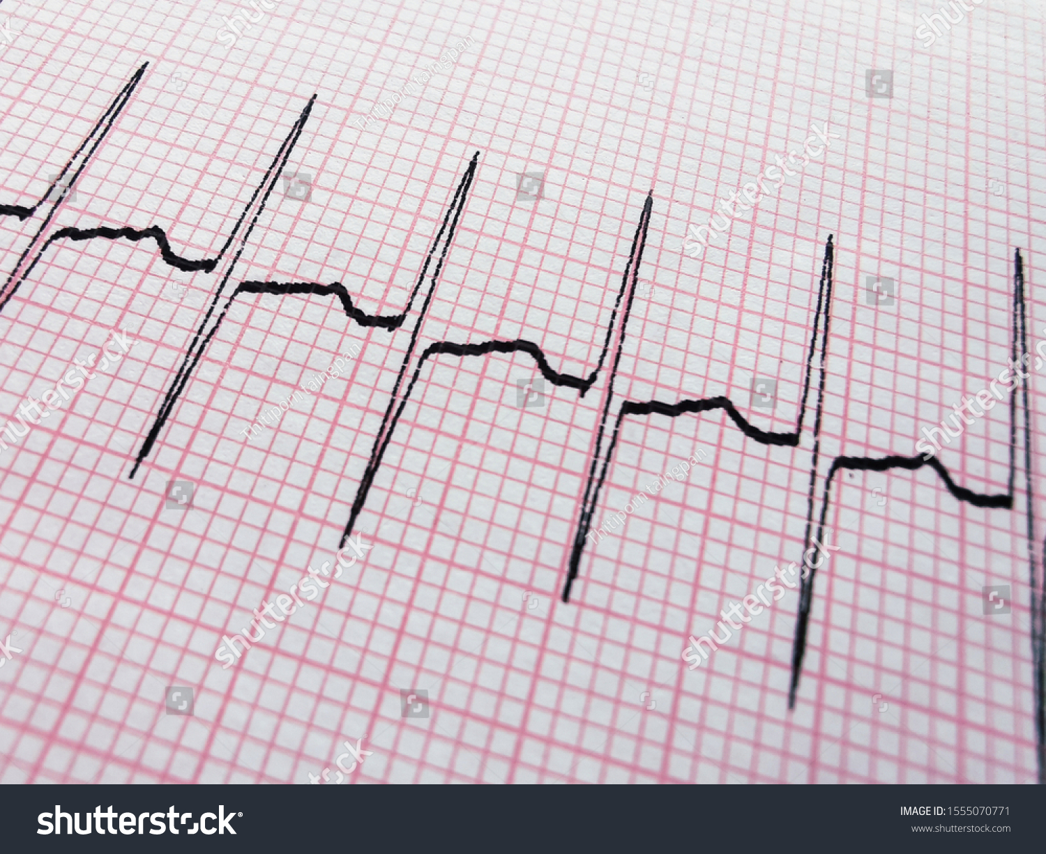 Ecg Results Supra Ventricular Tachycardia Stock Photo 1555070771 ...