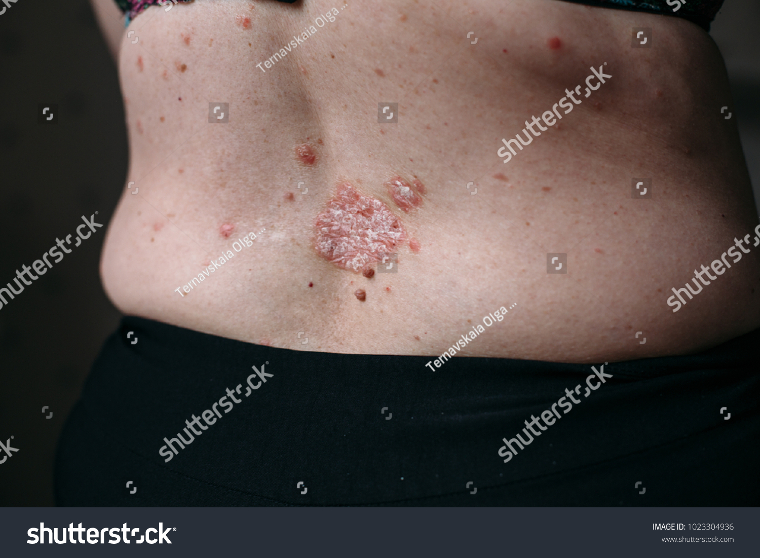 Eczema Atopic Dermatitis Symptom Skin Texture Stock Photo 1023304936