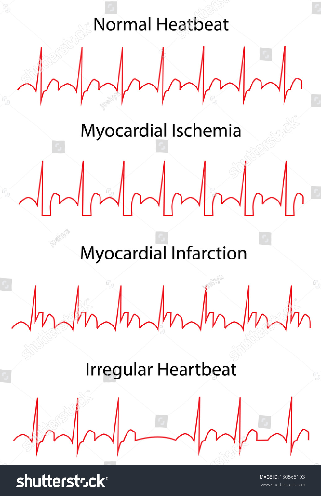 Ekg Normal Heartbeat Diseases Ecg 库存插图 180568193