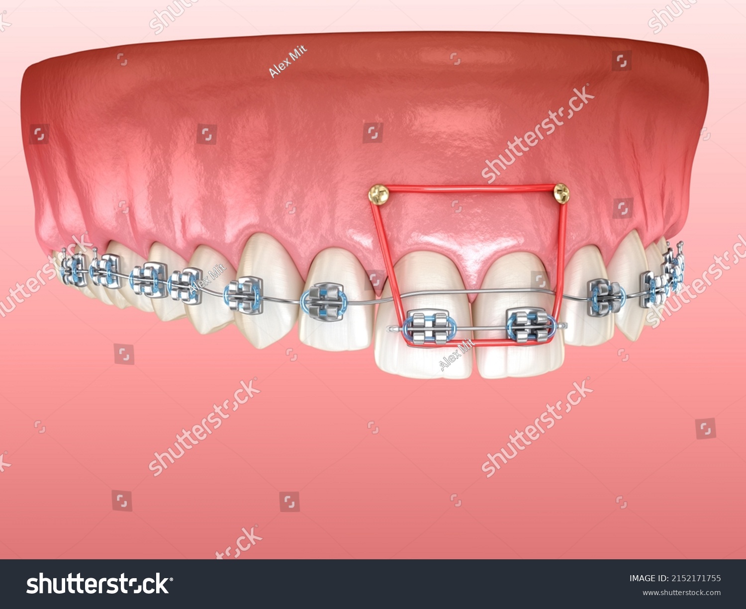 Elastics Metal Braces Correction Overbite Frontal Stock Illustration 2152171755 Shutterstock